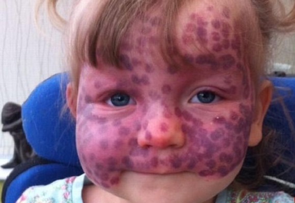 ماه‌گرفتگی نادر روی پوست یک کودک+عکس