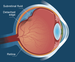 درمان جدا شدگی پرده شبکیه چشم