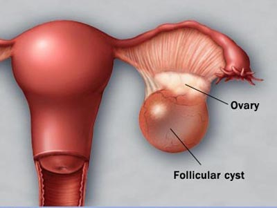 درمان سندرم تخمدان پُلی‌کیستیک از طریق طب سنتی :