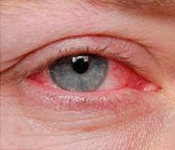 علایم عفونت چشم را بشناسید