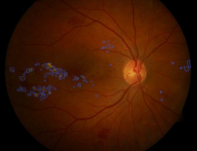 تشخیص بیماری چشمی ناشی از دیابت با کمک هوش مصنوعی
