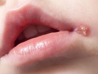 تبخال دهانی و عوامل بروز آن