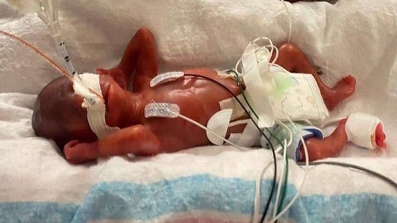 زودرس‌ترین نوزاد جهان: پسری که ۱۹ هفته زود به دنیا آمد + عکس